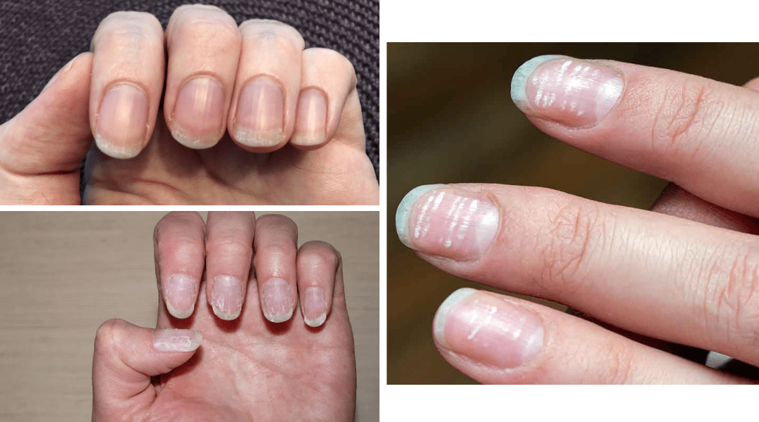 Three damaged fingernails showing peeling layers, white spots and ridges, and thin bendy texture—common signs of post-manicure nail stress.