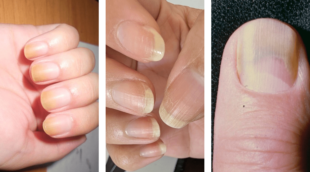 A close-up of a hand showing three types of yellow nail discoloration: one nail with light yellow staining, one with thick and slightly greenish fungal texture, and one with peeling, rough nail surface. The image illustrates key visual symptoms of yellow nails, including color changes, texture irregularities, and signs of fungal infection.