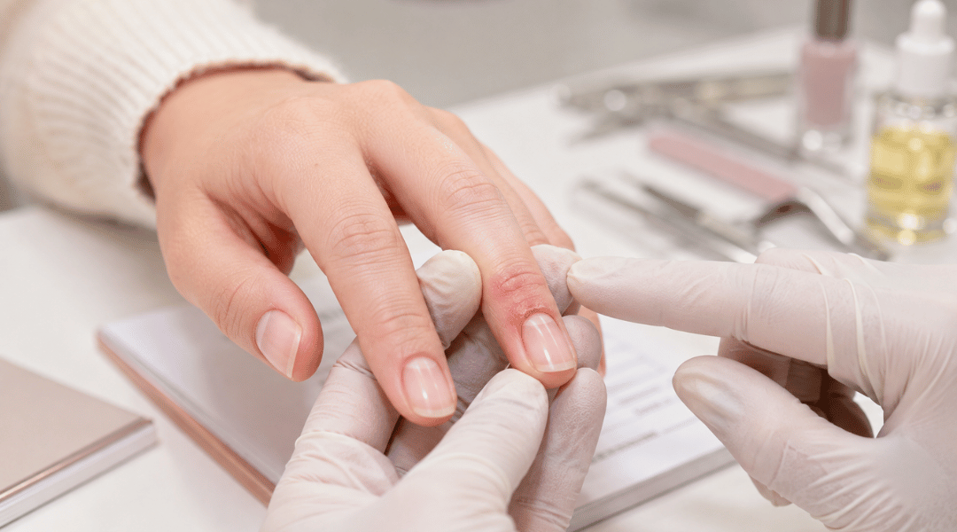 Close-up of a natural fingernail showing redness and mild swelling around the cuticle, illustrating why acrylic nails should not be applied over irritated or infected skin.